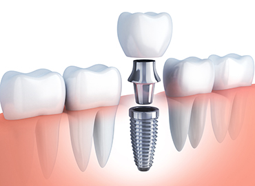 Implantatversorgung Zahnarzt Neumarkt